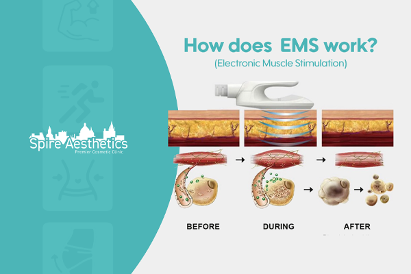 EMS treatment for post pregnancy weight loss treatment Craigentinny