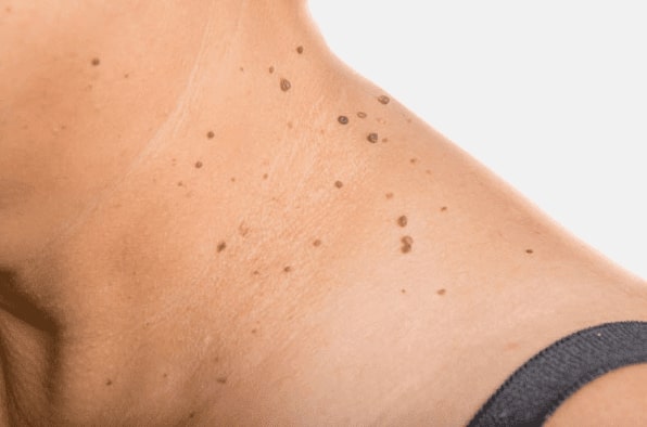 Are you looking for easy skin tag removal Craigentinny - then contact Spire today!