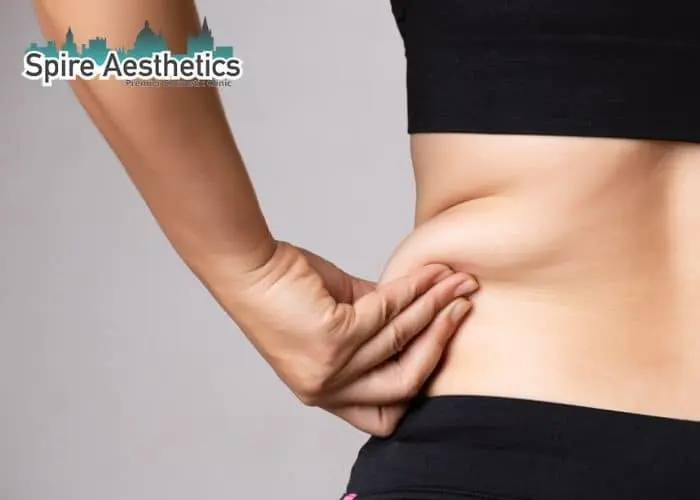 Image of woman pinching fat on their hips Craigentinny. Fat Freezing treatment