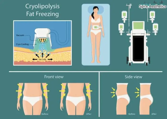 Fat freezing treatment Craigentinny benefits for competitions to remove stubborn fat deposits.