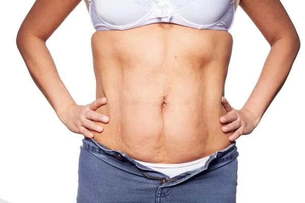 sagging skin on woman's stomach after weight loss injections Craigentinny