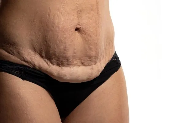 Image of womans stomach after weight loss injections Craigentinny showing saggy skin